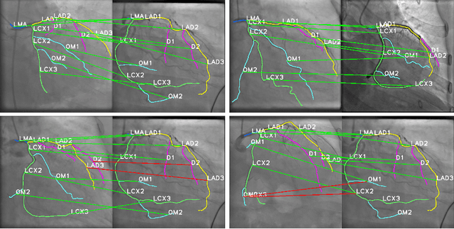 Figure 4 for Multi-graph Graph Matching for Coronary Artery Semantic Labeling