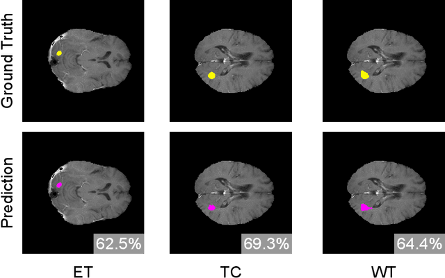 Figure 4 for 3D-TransUNet for Brain Metastases Segmentation in the BraTS2023 Challenge