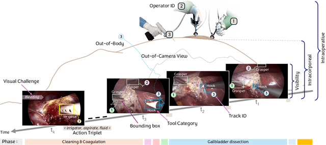 Figure 3 for SurgiTrack: Fine-Grained Multi-Class Multi-Tool Tracking in Surgical Videos