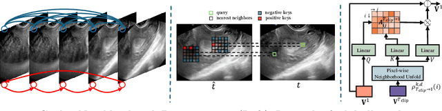 Figure 3 for LGRNet: Local-Global Reciprocal Network for Uterine Fibroid Segmentation in Ultrasound Videos