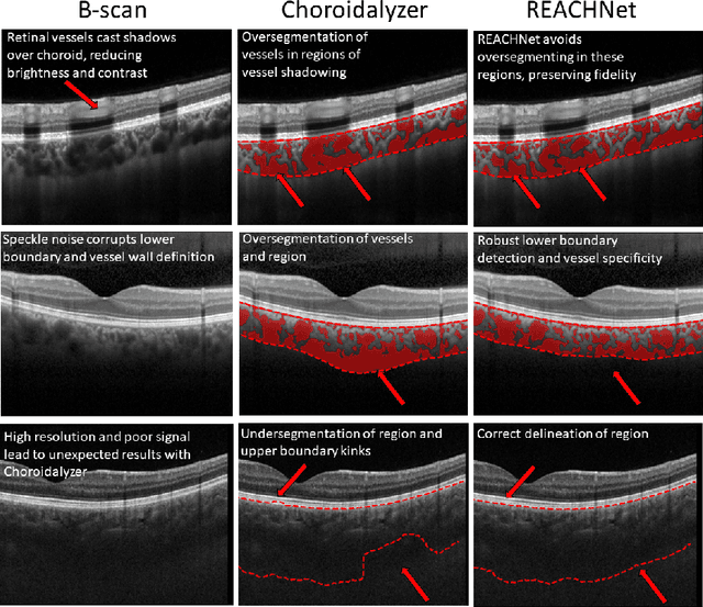 Figure 4 for Domain-specific augmentations with resolution agnostic self-attention mechanism improves choroid segmentation in optical coherence tomography images