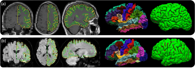 Figure 4 for Cortical analysis of heterogeneous clinical brain MRI scans for large-scale neuroimaging studies