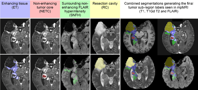 Figure 4 for The 2024 Brain Tumor Segmentation (BraTS) Challenge: Glioma Segmentation on Post-treatment MRI