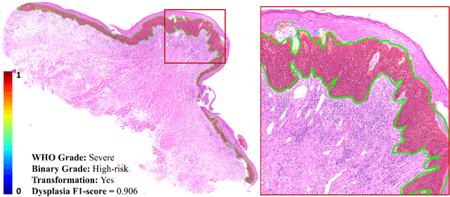 Figure 4 for Transformer-based Model for Oral Epithelial Dysplasia Segmentation