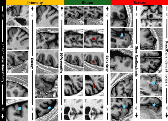 Figure 3 for Interpretability of Uncertainty: Exploring Cortical Lesion Segmentation in Multiple Sclerosis