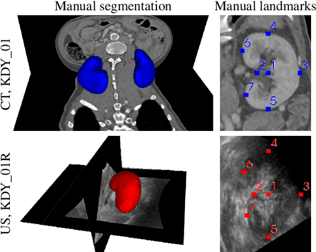 Figure 1 for TRUSTED: The Paired 3D Transabdominal Ultrasound and CT Human Data for Kidney Segmentation and Registration Research