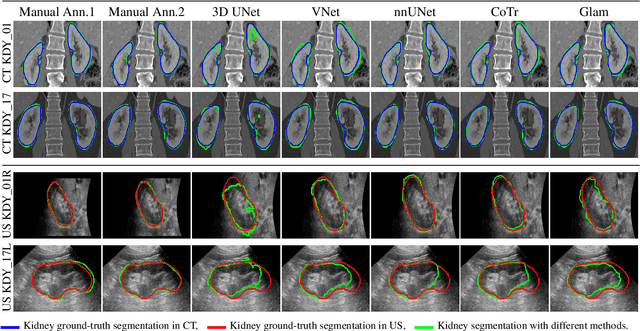 Figure 4 for TRUSTED: The Paired 3D Transabdominal Ultrasound and CT Human Data for Kidney Segmentation and Registration Research