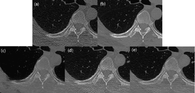 Figure 2 for QS-ADN: Quasi-Supervised Artifact Disentanglement Network for Low-Dose CT Image Denoising by Local Similarity Among Unpaired Data