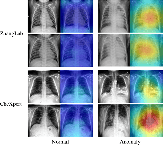 Figure 2 for Weakly Supervised Anomaly Detection for Chest X-Ray Image