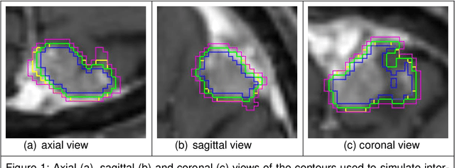 Figure 1 for Analysis of clinical, dosimetric and radiomic features for predicting local failure after stereotactic radiotherapy of brain metastases in malignant melanoma