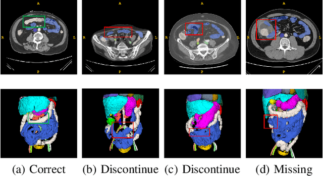 Figure 1 for AG-CRC: Anatomy-Guided Colorectal Cancer Segmentation in CT with Imperfect Anatomical Knowledge