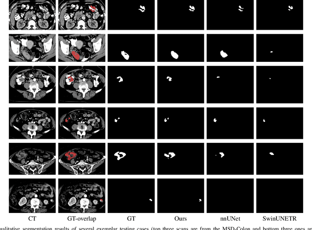 Figure 4 for AG-CRC: Anatomy-Guided Colorectal Cancer Segmentation in CT with Imperfect Anatomical Knowledge