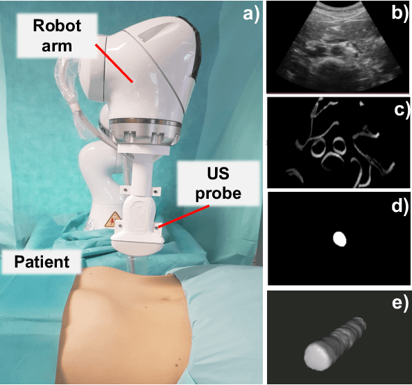 Figure 1 for Implicit Neural Representations for Breathing-compensated Volume Reconstruction in Robotic Ultrasound Aorta Screening