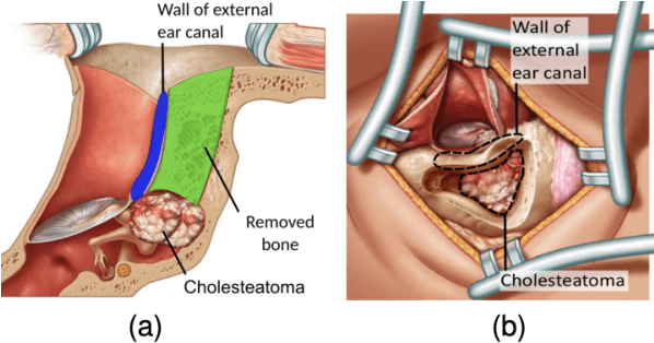 Figure 3 for Safe Path following for Middle Ear Surgery