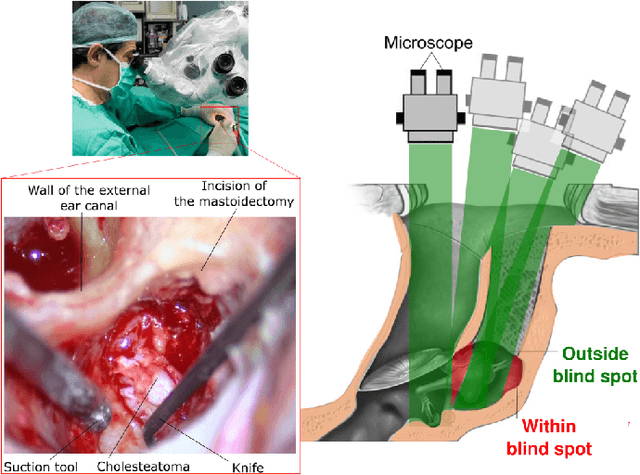 Figure 4 for Safe Path following for Middle Ear Surgery