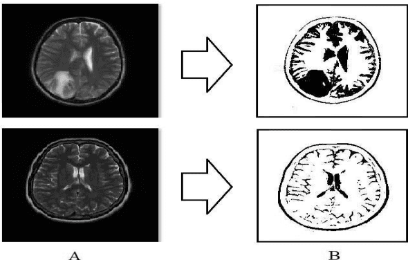 Figure 3 for Advancing Brain Tumor Detection: A Thorough Investigation of CNNs, Clustering, and SoftMax Classification in the Analysis of MRI Images