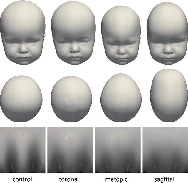 Figure 4 for Impact of Data Synthesis Strategies for the Classification of Craniosynostosis