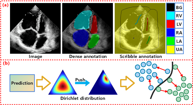 Figure 1 for MambaEviScrib: Mamba and Evidence-Guided Consistency Make CNN Work Robustly for Scribble-Based Weakly Supervised Ultrasound Image Segmentation