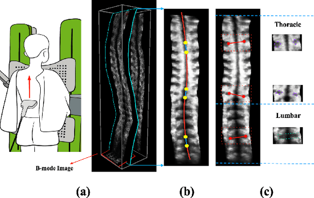 Figure 1 for Automatic Ultrasound Curve Angle Measurement via Affinity Clustering for Adolescent Idiopathic Scoliosis Evaluation