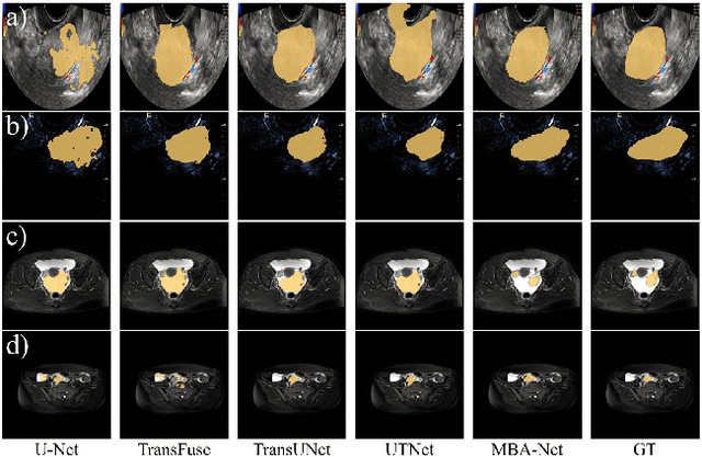 Figure 4 for MBA-Net: SAM-driven Bidirectional Aggregation Network for Ovarian Tumor Segmentation