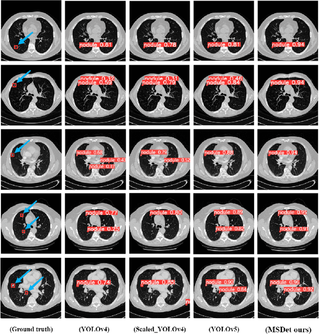 Figure 2 for MSDet: Receptive Field Enhanced Multiscale Detection for Tiny Pulmonary Nodule