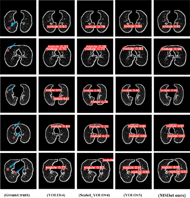 Figure 3 for MSDet: Receptive Field Enhanced Multiscale Detection for Tiny Pulmonary Nodule