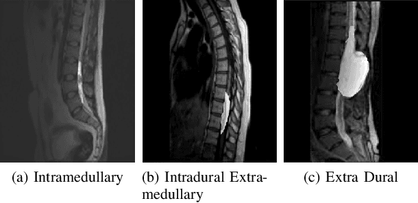 Figure 1 for Lumbar Spine Tumor Segmentation and Localization in T2 MRI Images Using AI