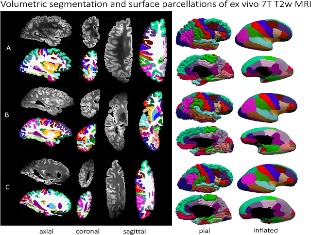 Figure 2 for Surface-based parcellation and vertex-wise analysis of ultra high-resolution ex vivo 7 tesla MRI in neurodegenerative diseases