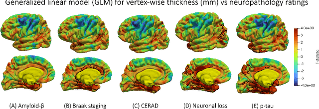 Figure 4 for Surface-based parcellation and vertex-wise analysis of ultra high-resolution ex vivo 7 tesla MRI in neurodegenerative diseases