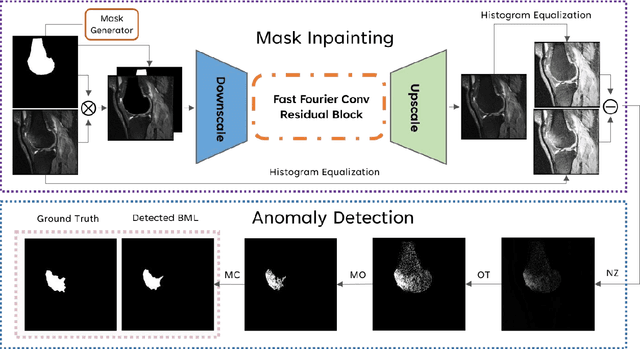 Figure 1 for Semi-Supervised Bone Marrow Lesion Detection from Knee MRI Segmentation Using Mask Inpainting Models