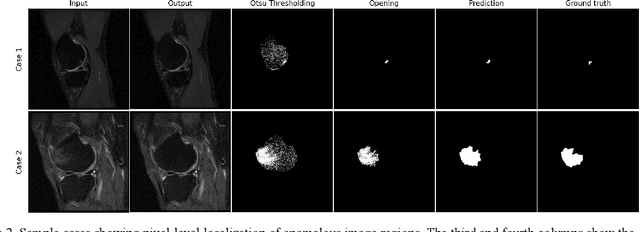 Figure 3 for Semi-Supervised Bone Marrow Lesion Detection from Knee MRI Segmentation Using Mask Inpainting Models