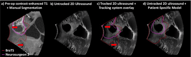 Figure 1 for Patient-Specific Real-Time Segmentation in Trackerless Brain Ultrasound