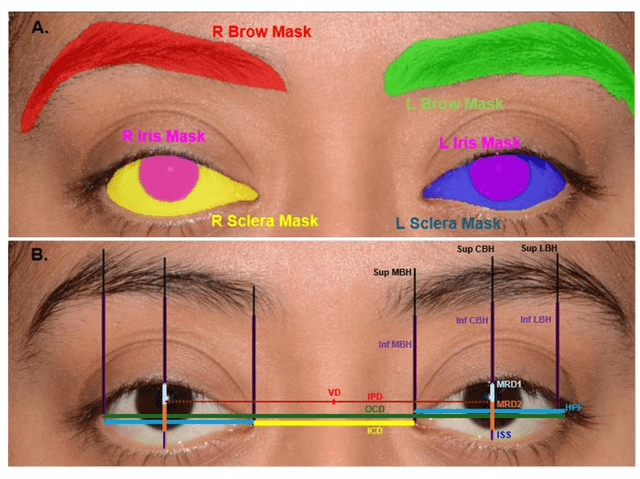 Figure 1 for State-of-the-Art Periorbital Distance Prediction and Disease Classification Using Periorbital Features