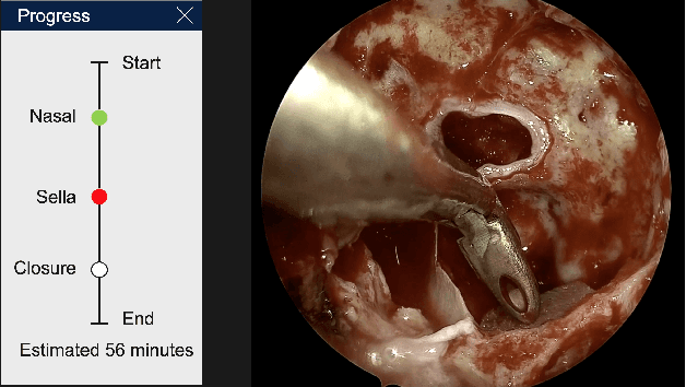 Figure 1 for PitRSDNet: Predicting Intra-operative Remaining Surgery Duration in Endoscopic Pituitary Surgery