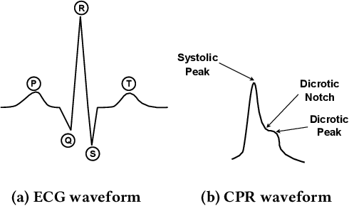 Figure 4 for AcousAF: Acoustic Sensing-Based Atrial Fibrillation Detection System for Mobile Phones