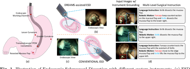 Figure 1 for CoPESD: A Multi-Level Surgical Motion Dataset for Training Large Vision-Language Models to Co-Pilot Endoscopic Submucosal Dissection