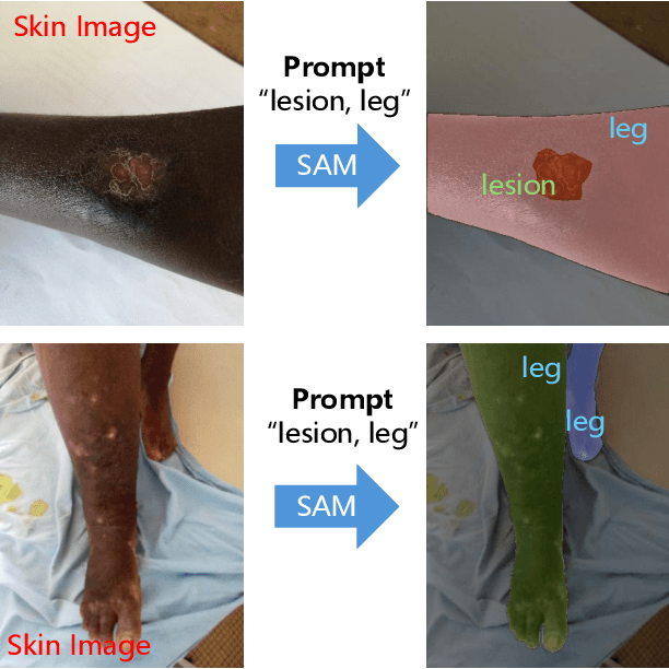 Figure 1 for Enhancing Skin Disease Diagnosis: Interpretable Visual Concept Discovery with SAM Empowerment