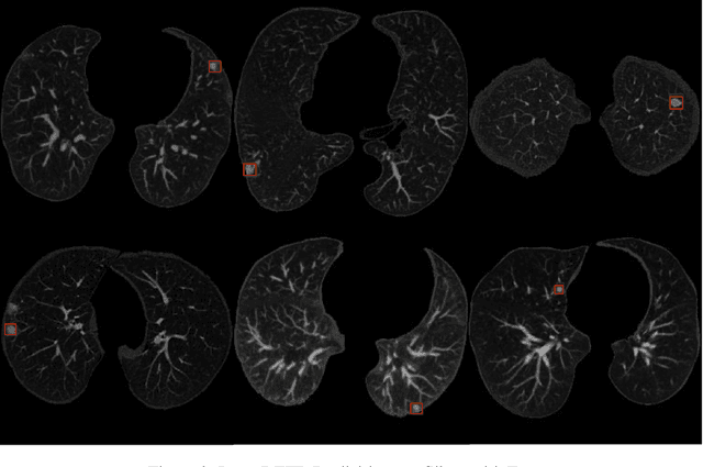 Figure 4 for Lung-DETR: Deformable Detection Transformer for Sparse Lung Nodule Anomaly Detection