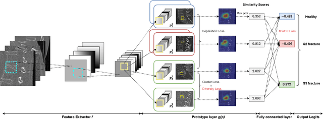 Figure 3 for Enhancing Interpretability of Vertebrae Fracture Grading using Human-interpretable Prototypes