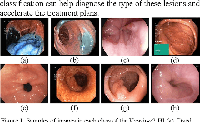 Figure 1 for Endoscopy Classification Model Using Swin Transformer and Saliency Map