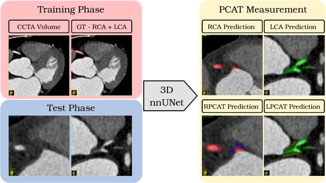 Figure 1 for Automated Measurement of Pericoronary Adipose Tissue Attenuation and Volume in CT Angiography