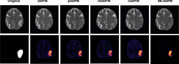 Figure 2 for MCDDPM: Multichannel Conditional Denoising Diffusion Model for Unsupervised Anomaly Detection in Brain MRI