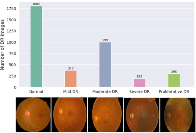 Figure 1 for Controllable retinal image synthesis using conditional StyleGAN and latent space manipulation for improved diagnosis and grading of diabetic retinopathy