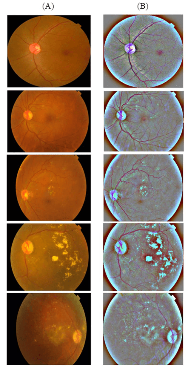 Figure 3 for Controllable retinal image synthesis using conditional StyleGAN and latent space manipulation for improved diagnosis and grading of diabetic retinopathy