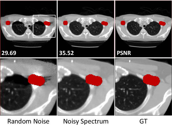 Figure 3 for Unsupervised Density Neural Representation for CT Metal Artifact Reduction