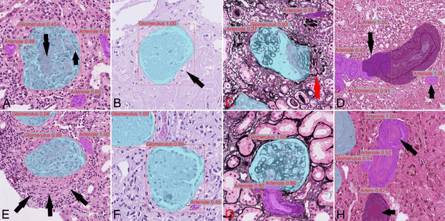 Figure 4 for Segmentation of diagnostic tissue compartments on whole slide images with renal thrombotic microangiopathies (TMAs)