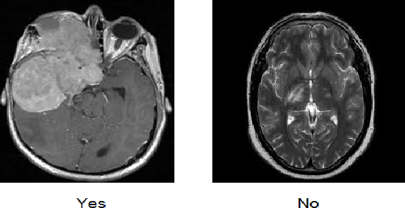 Figure 1 for Brain Tumor Classification on MRI in Light of Molecular Markers