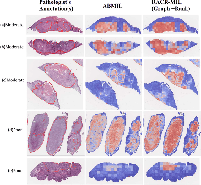 Figure 2 for RACR-MIL: Weakly Supervised Skin Cancer Grading using Rank-Aware Contextual Reasoning on Whole Slide Images