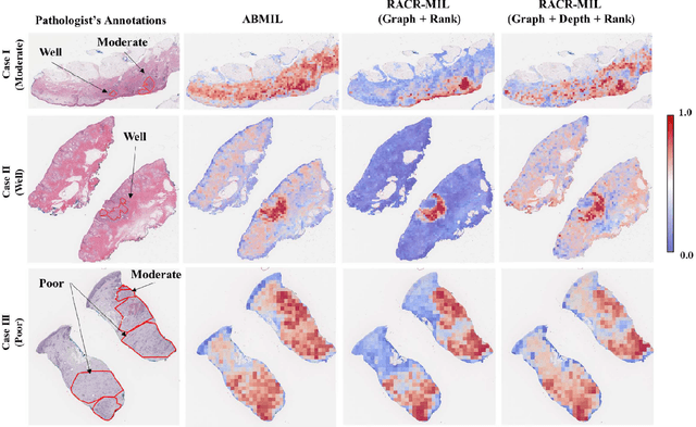 Figure 4 for RACR-MIL: Weakly Supervised Skin Cancer Grading using Rank-Aware Contextual Reasoning on Whole Slide Images