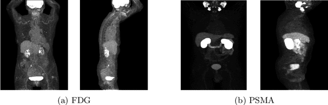 Figure 3 for Autopet III challenge: Incorporating anatomical knowledge into nnUNet for lesion segmentation in PET/CT